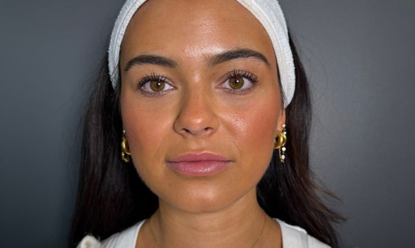 Restylane lip filler before and after showing subtle lip enhancement with improved volume, definition, and natural-looking results