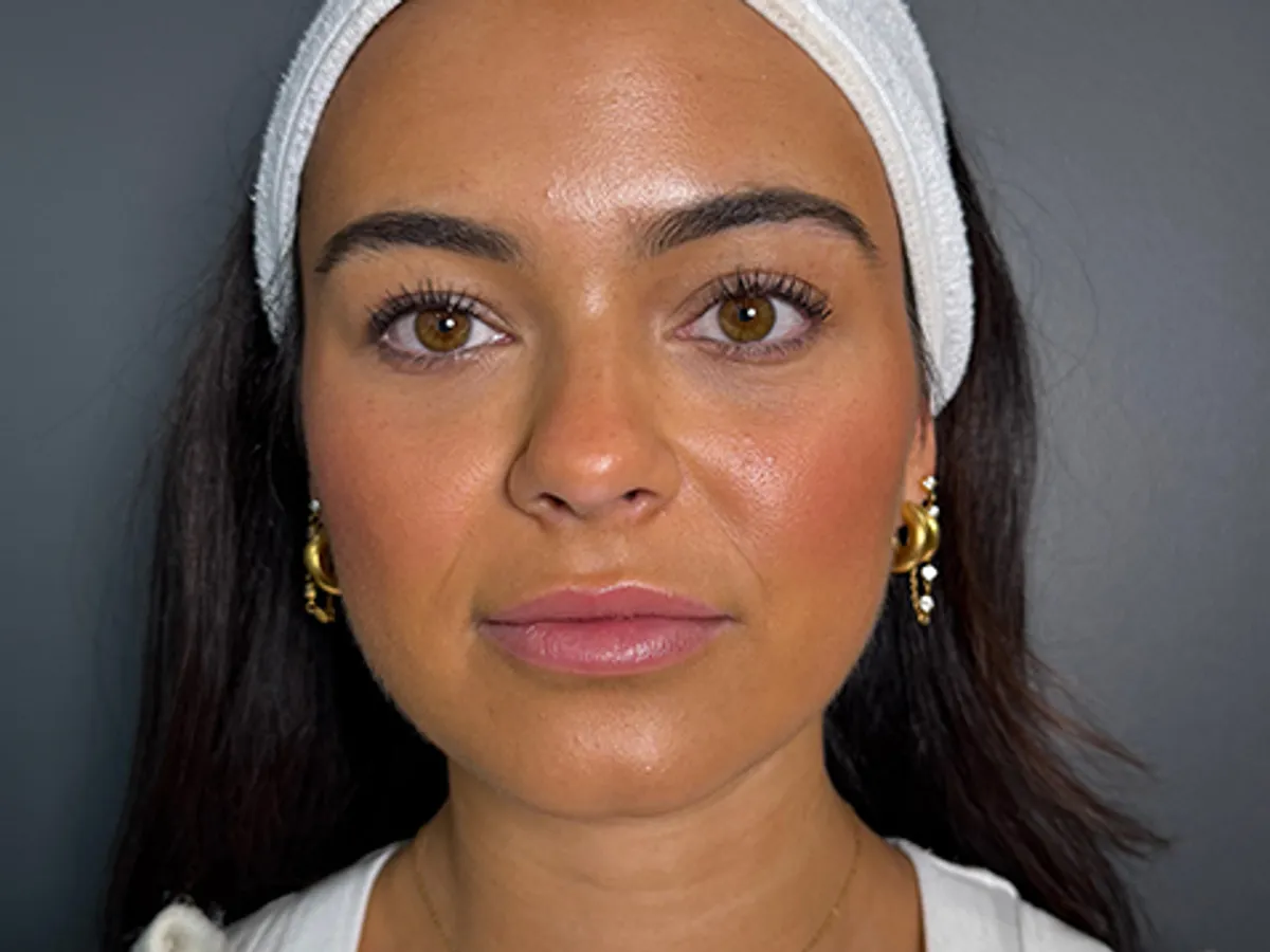 Restylane lip filler before and after showing subtle lip enhancement with improved volume, definition, and natural-looking results