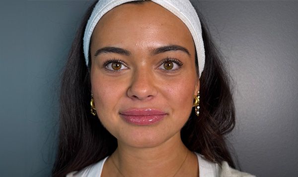 Restylane lip filler before and after showing subtle lip enhancement with improved volume, definition, and natural-looking results
