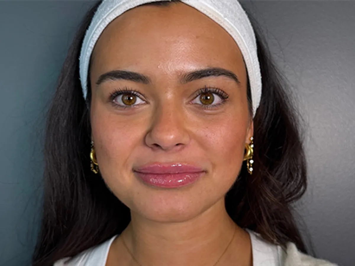 Restylane lip filler before and after showing subtle lip enhancement with improved volume, definition, and natural-looking results