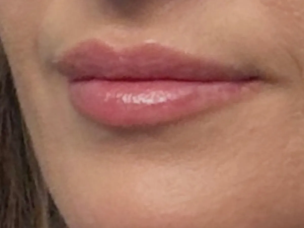 Restylane lip filler before and after showing natural-looking lip enhancement with improved volume, smooth texture, and defined lip shape