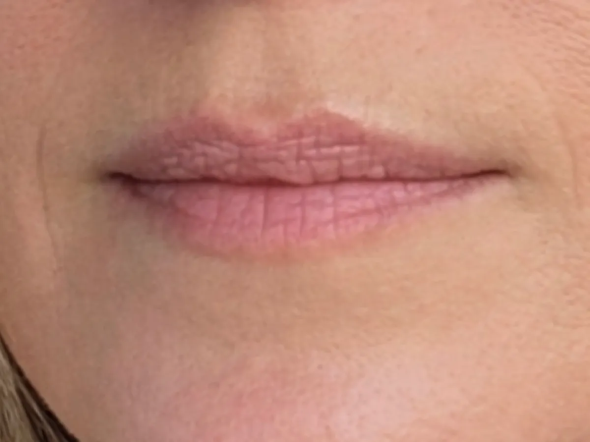 Restylane lip filler before and after showing natural-looking lip enhancement with improved volume, smooth texture, and defined lip shape