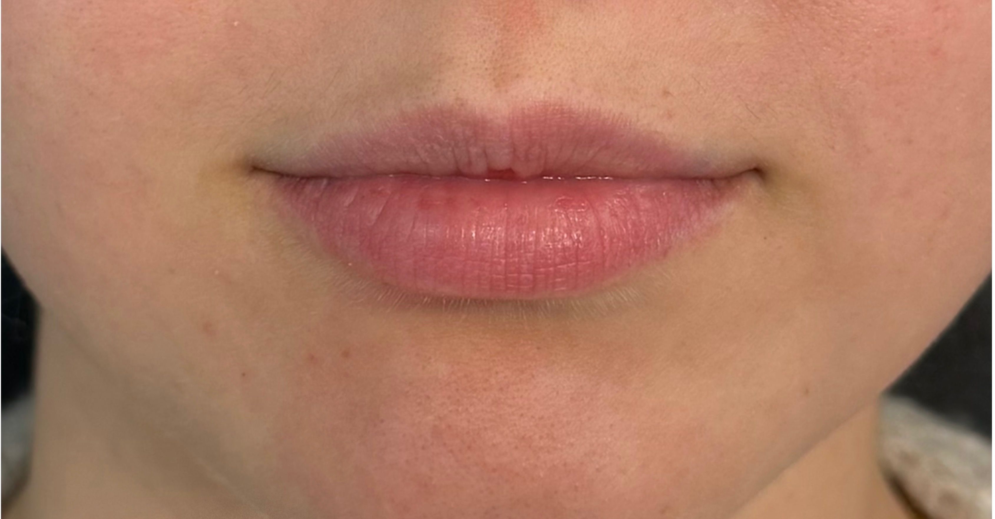 Restylane lip filler before and after showing enhanced lip volume, improved definition, and a smooth, natural-looking result