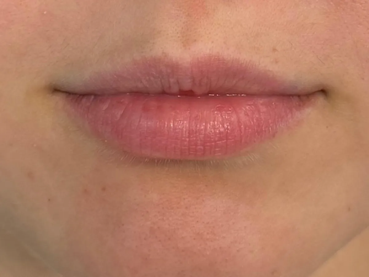 Restylane lip filler before and after showing enhanced lip volume, improved definition, and a smooth, natural-looking result