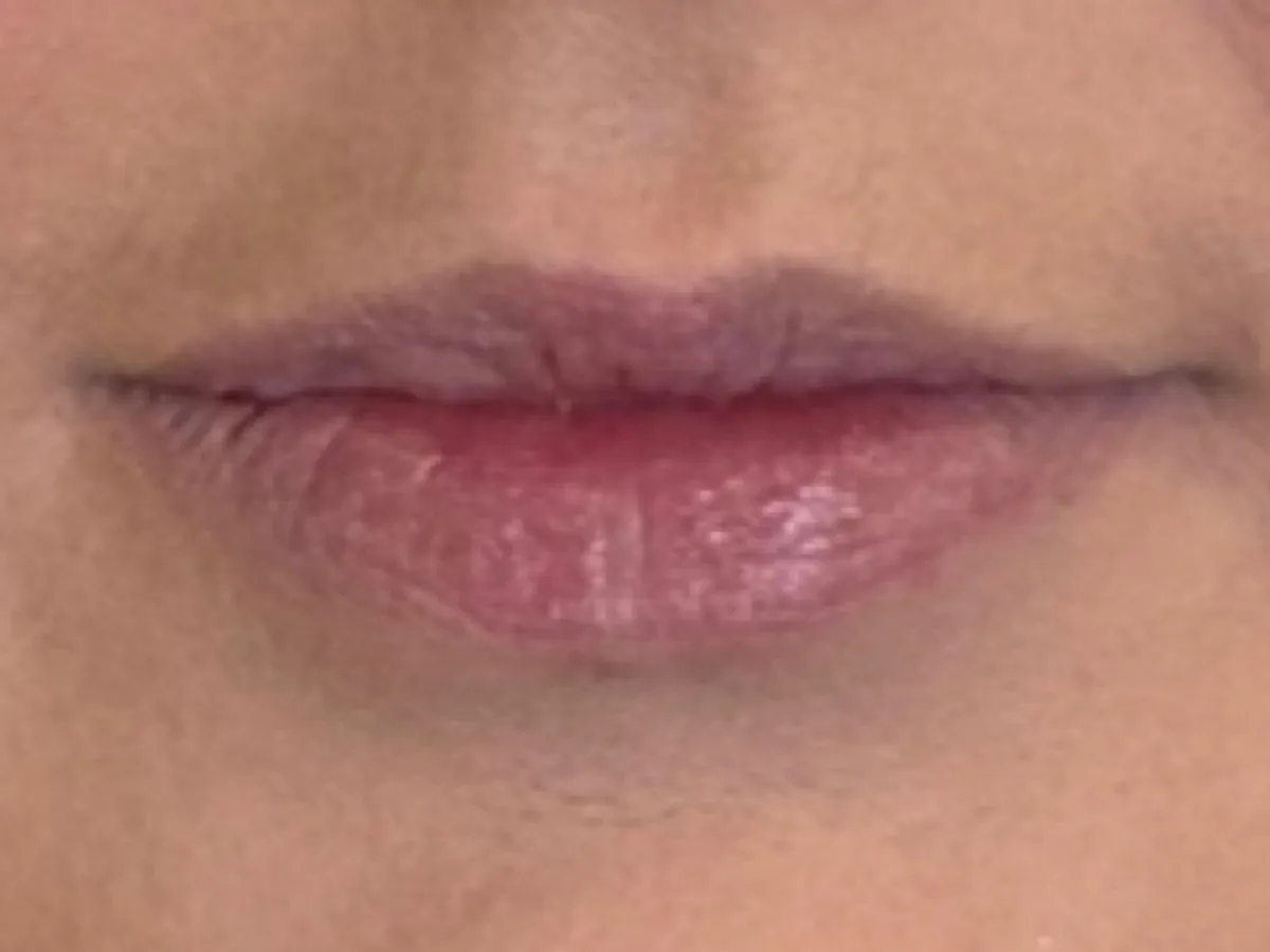 Restylane lip filler before and after showing natural-looking lip enhancement with improved volume, smooth texture, and defined lip shape