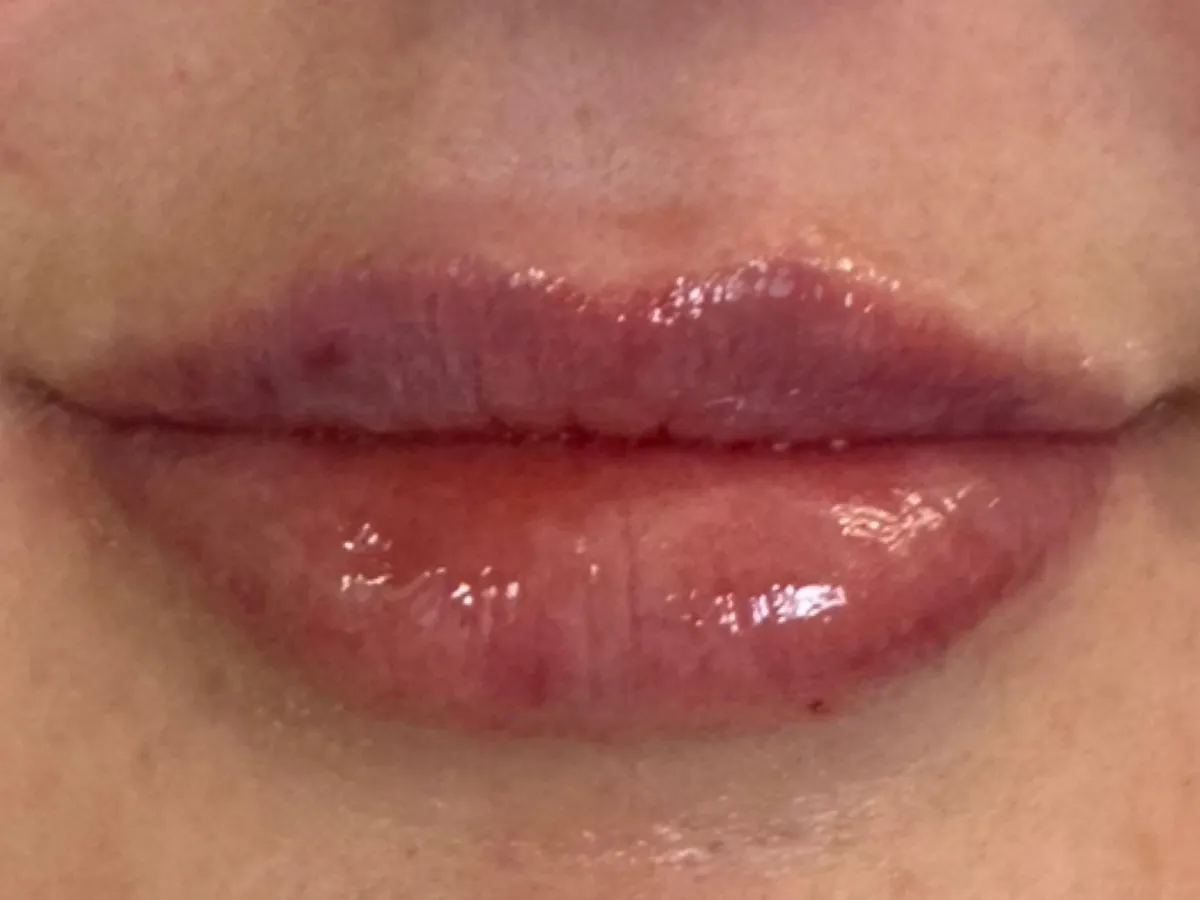 Restylane lip filler before and after showing natural-looking lip enhancement with improved volume, smooth texture, and defined lip shape