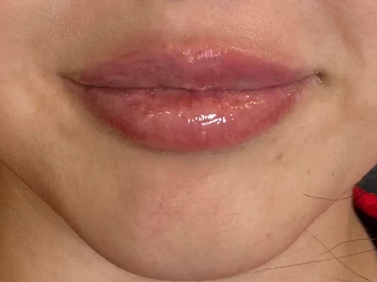 Restylane lip filler before and after showing enhanced lip volume, improved definition, and a smooth, natural-looking result